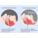 Schnarchschiene + Knierschschiene Quality sleep